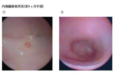 内視鏡検査所見（約１ヶ月半後）